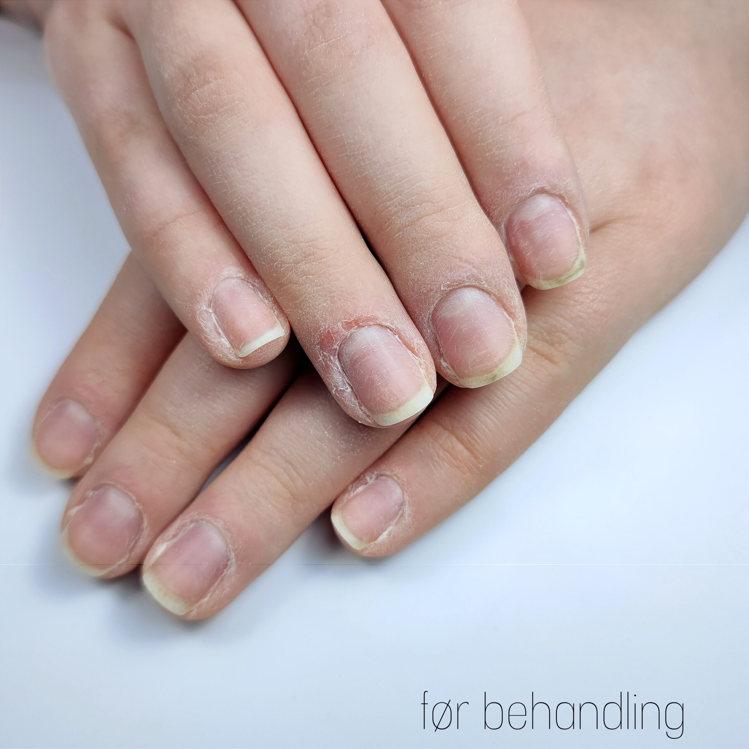 bebeauty-kristiansand-neglesykdommer2